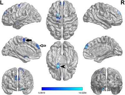 Regional homogeneity and functional connectivity of freezing of gait conversion in Parkinson’s disease